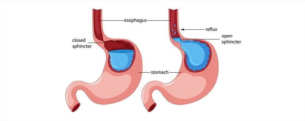Anti-Reflux Surgery | GERD Relief | Treating Heartburn & Hiatal Hernia ...
